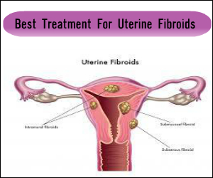 What is the Best Treatment For Uterine Fibroids