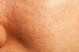 how to get rid of large pores