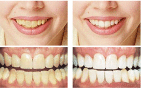 What Is The Best Over The Counter Teeth Whitening Product2