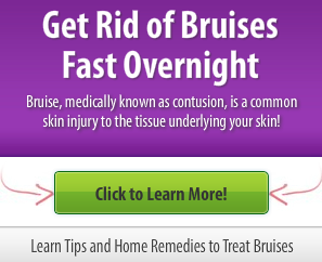 how to get rid of bruises fast overnight