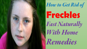 how to get rid of freckles fast naturally