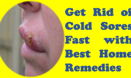 How to Get Rid of Cold Sores Fast with Natural Home Remedies