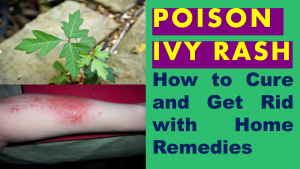 how to cure poison ivy rash fast